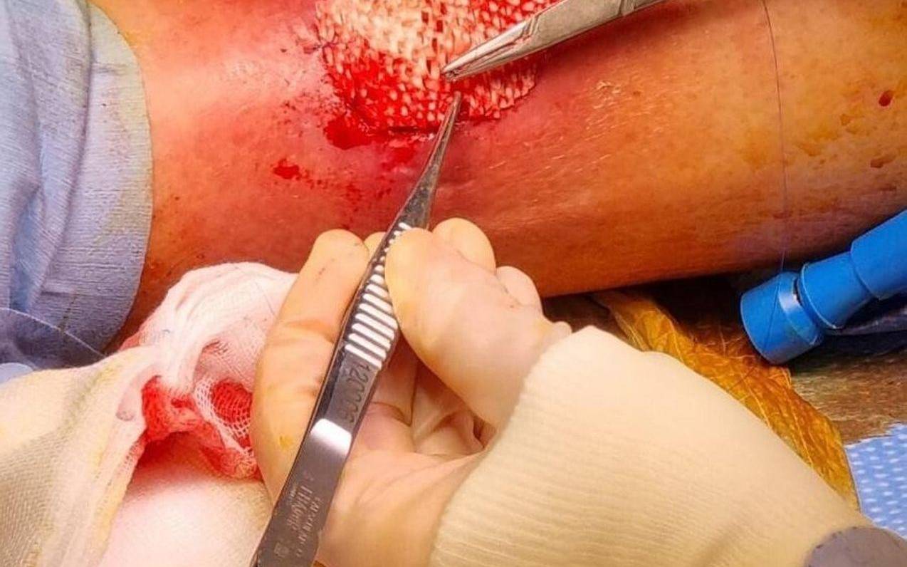 Fischhaut zur Behandlung von großen Wunden